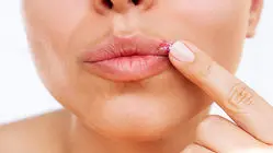 آیا می‌توان برای همیشه از شر تبخال خلاص شد؟