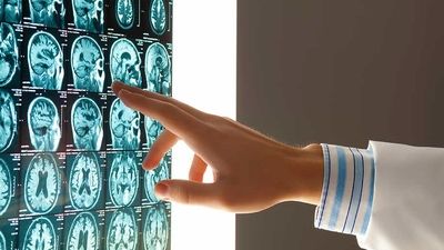 کاهش سن ابتلا به سکته مغزی