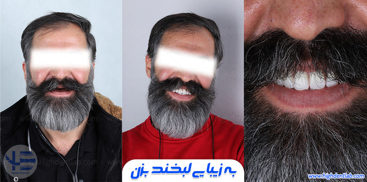 سیر تا پیاز دندان مصنوعی