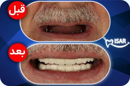 ایمپلنت و ارتودنسی و کامپوزیت دندان