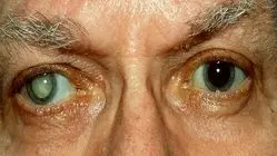 راه تشخیص فوری آب مروارید چشم + فیلم