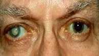 راه تشخیص فوری آب مروارید چشم + فیلم