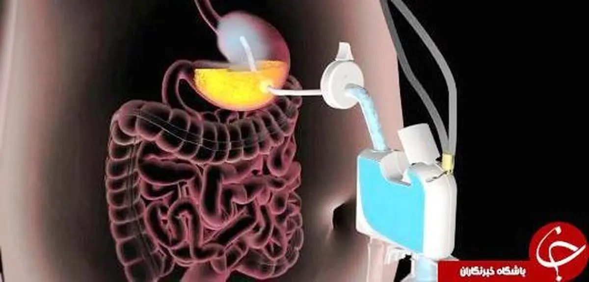 جدیدترین دستگاه لاغری بدون جراحی