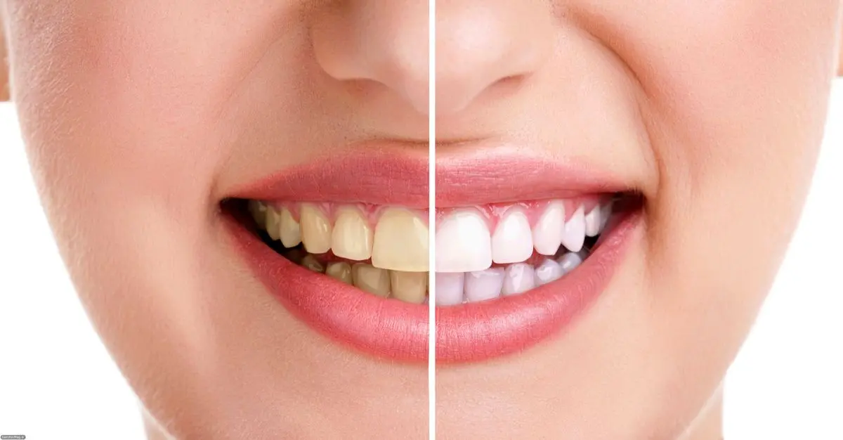 آیا تبلیغات جدید در مورد سفید کردن دندان با لیزر صحت دارد؟
