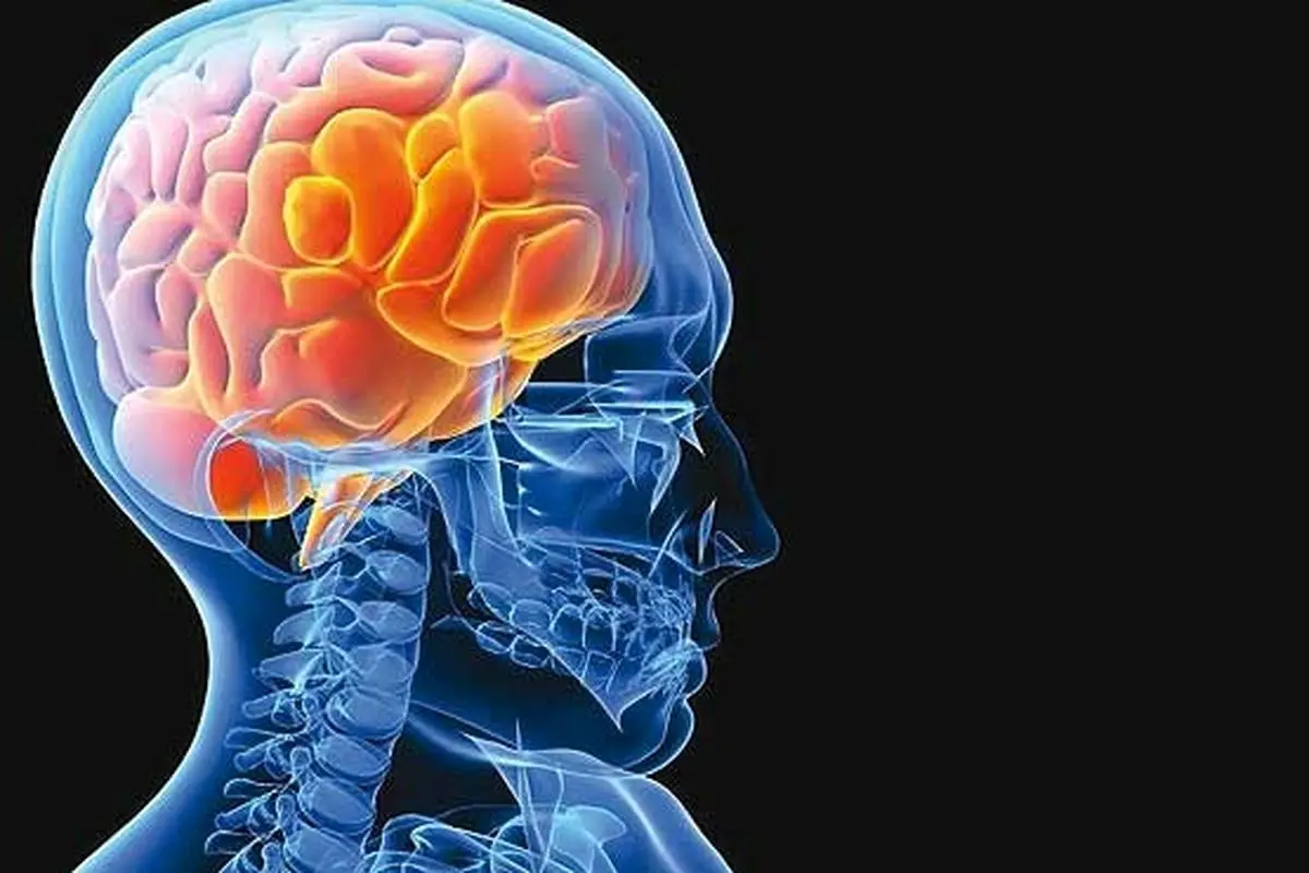 چگونه احتمال سکته مغزی را تا ۹۰ درصد کاهش دهیم؟