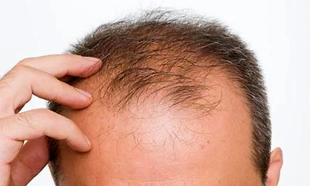 چهار روش برای جلوگیری از ریزش مو