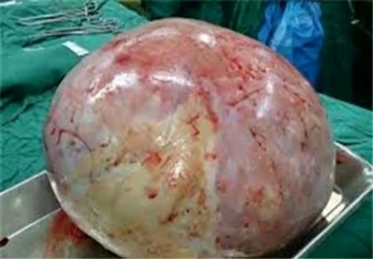 خارج کردن توده ۴٫۵کیلویی از شکم بانوی ۱۸ساله