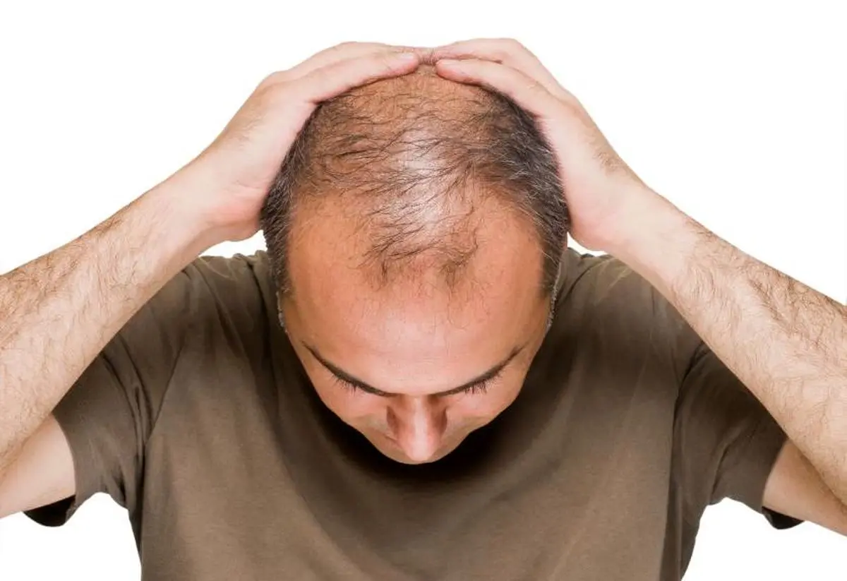بررسی مهم ترین نکاتی که باید درباره کاشت مو بدانید