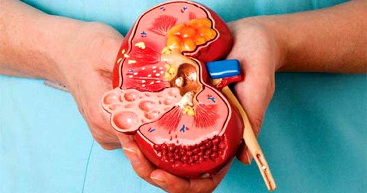چرا ایرانیها زیاد سنگ کلیه میگیرند؟