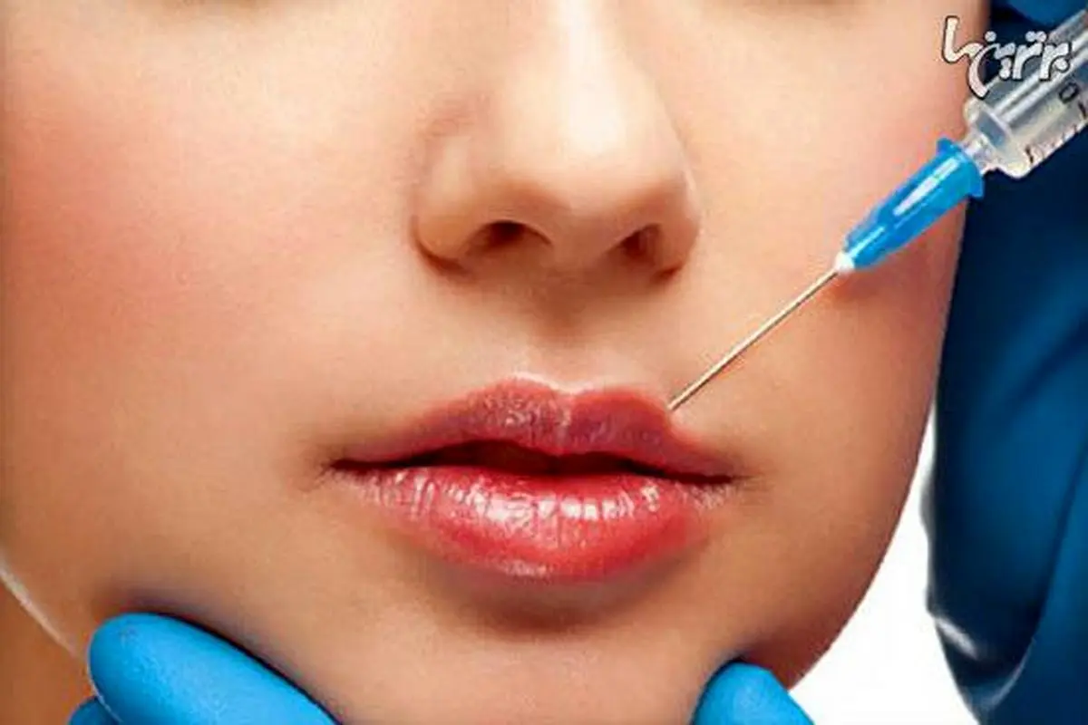 حقایق ناگفته درباره تزریق ژل به لب