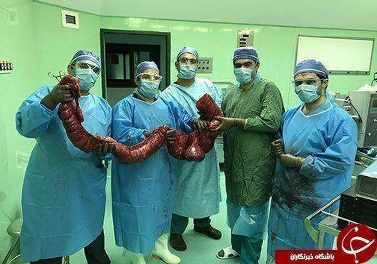 خارج کردن روده بزرگ ۸ کیلویی در بابل