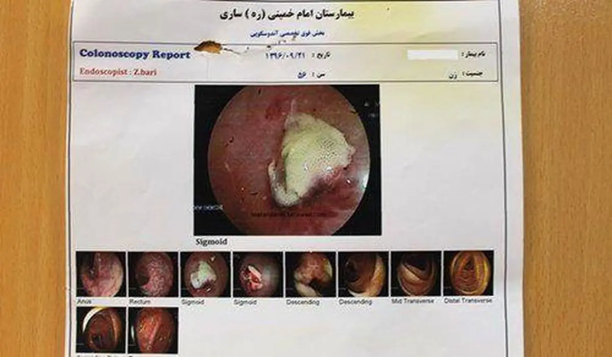 خارج کردن باند استریل پس از ۱۰ سال از بدن بیمار