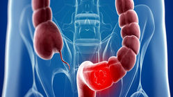 پیشگیری از سرطان روده با یک خوراکی ساده