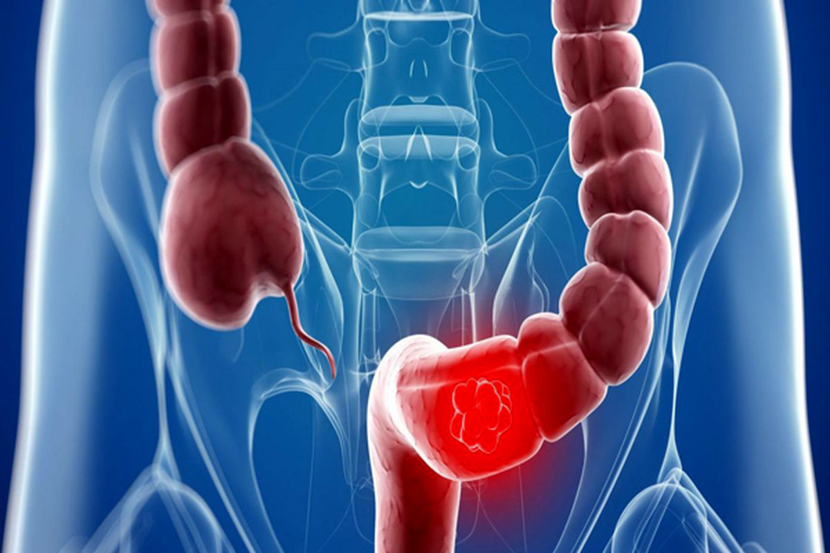 پیشگیری از سرطان روده با یک خوراکی ساده