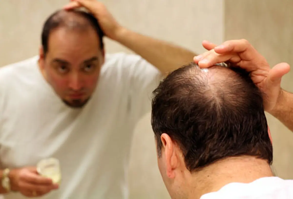 کاهش وزن چه ارتباطی با ریزش مو دارد؟