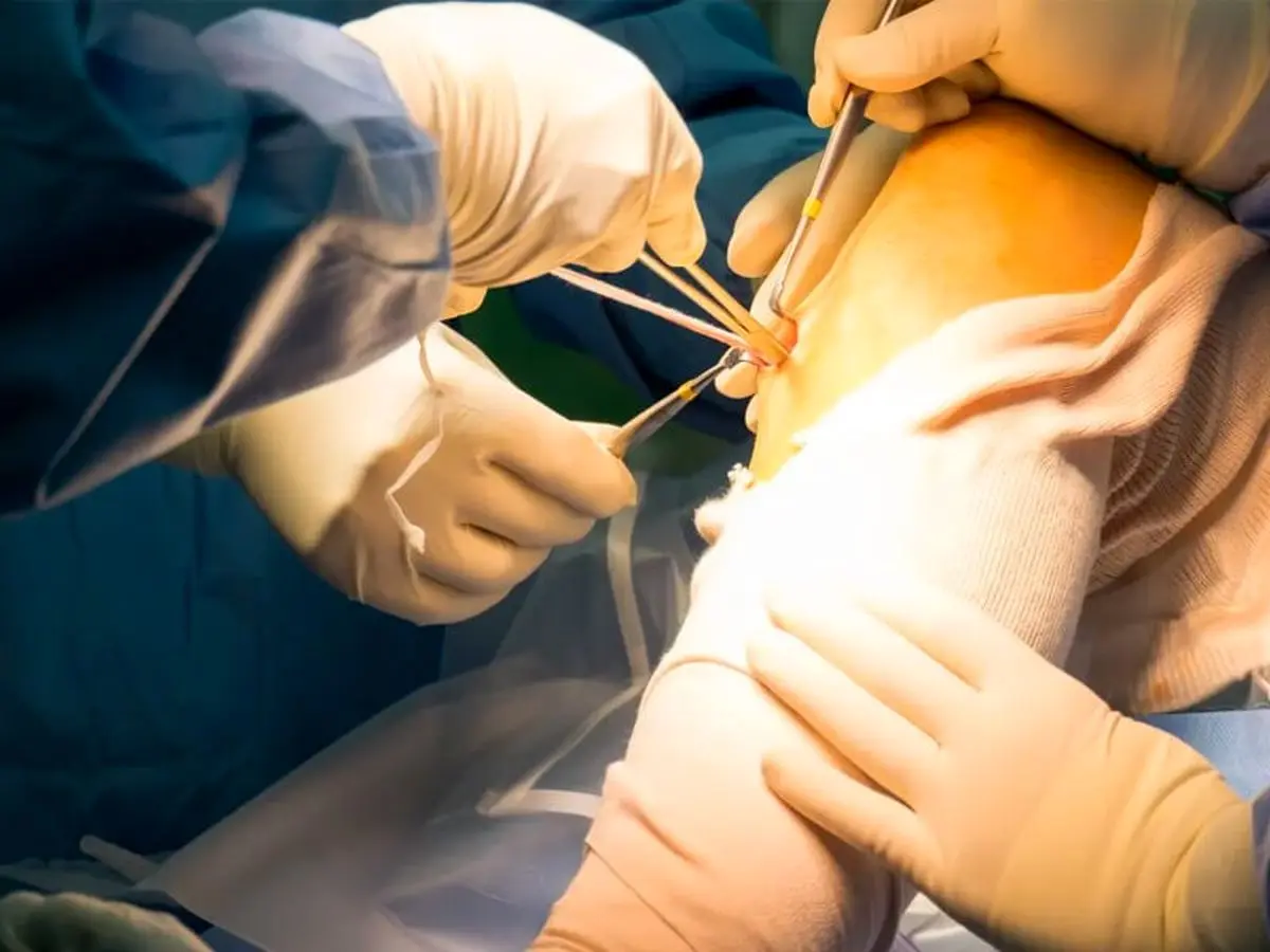 5 دلیل آسیب‌دیدگی رباط صلیبی قدامی + روش درمان