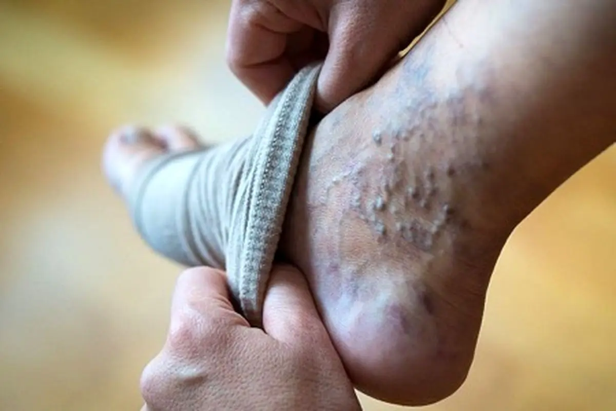 معرفی 5 روش درمان واریس در طب سنتی که معجزه می‌کند!