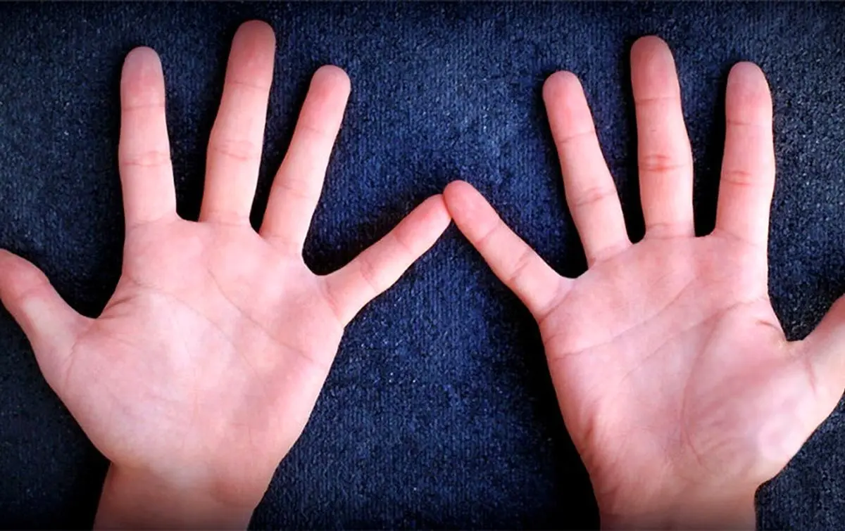 خارش کف دست خبر از پول می‌دهد یا بیماری؟