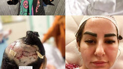 ماجرای زنی که ‌مورد حمله سگ پیت‌بول قرار گرفت