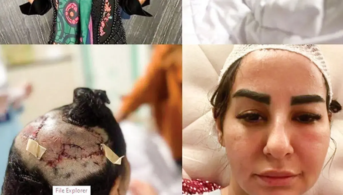 ماجرای زنی که ‌مورد حمله سگ پیت‌بول قرار گرفت