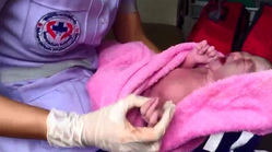 تولد نوزاد ۲۴ انگشتی در تایلند