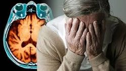 آلزایمر و زوال عقل