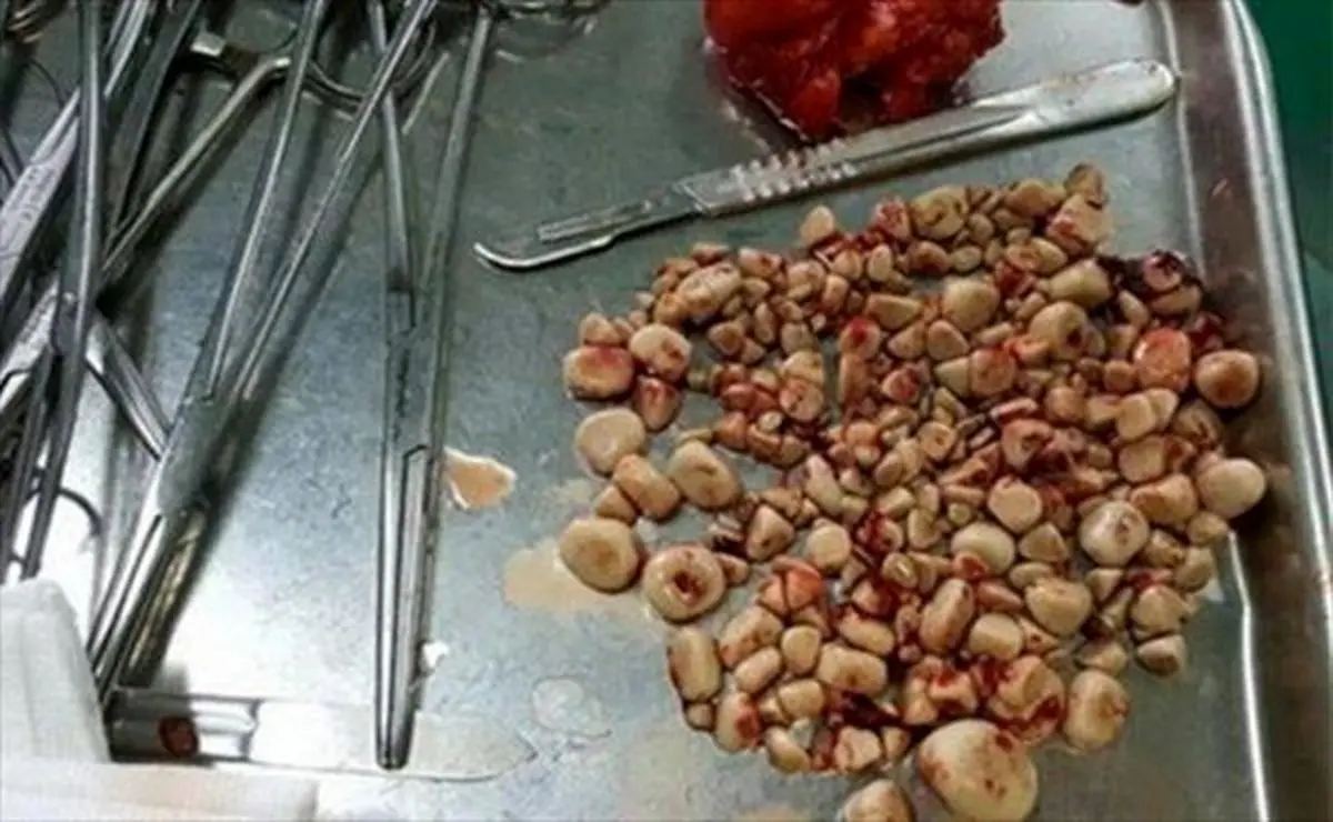 خطر سنگ کلیه چه‌کسانی را تهدید می‌کند؟