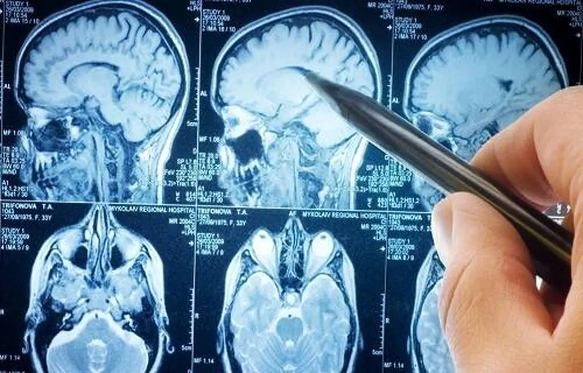کرونا مغز مبتلایان را ۱۰سال پیر می‌کند