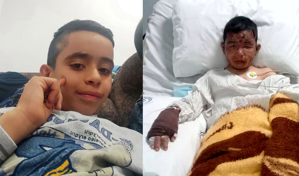 کودک فداکاری که سوخت و جان ۴کودک دیگر را نجات داد