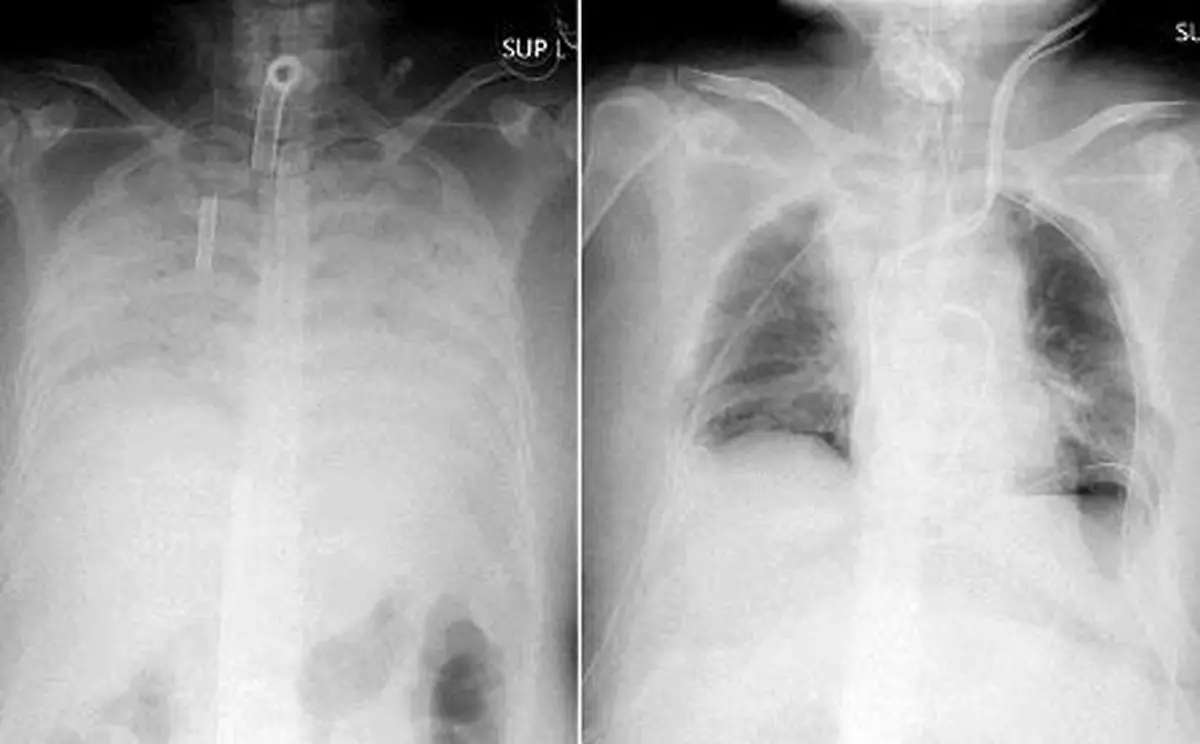 نجات بیمار ‌مبتلا به کرونا با پیوند ریه!
