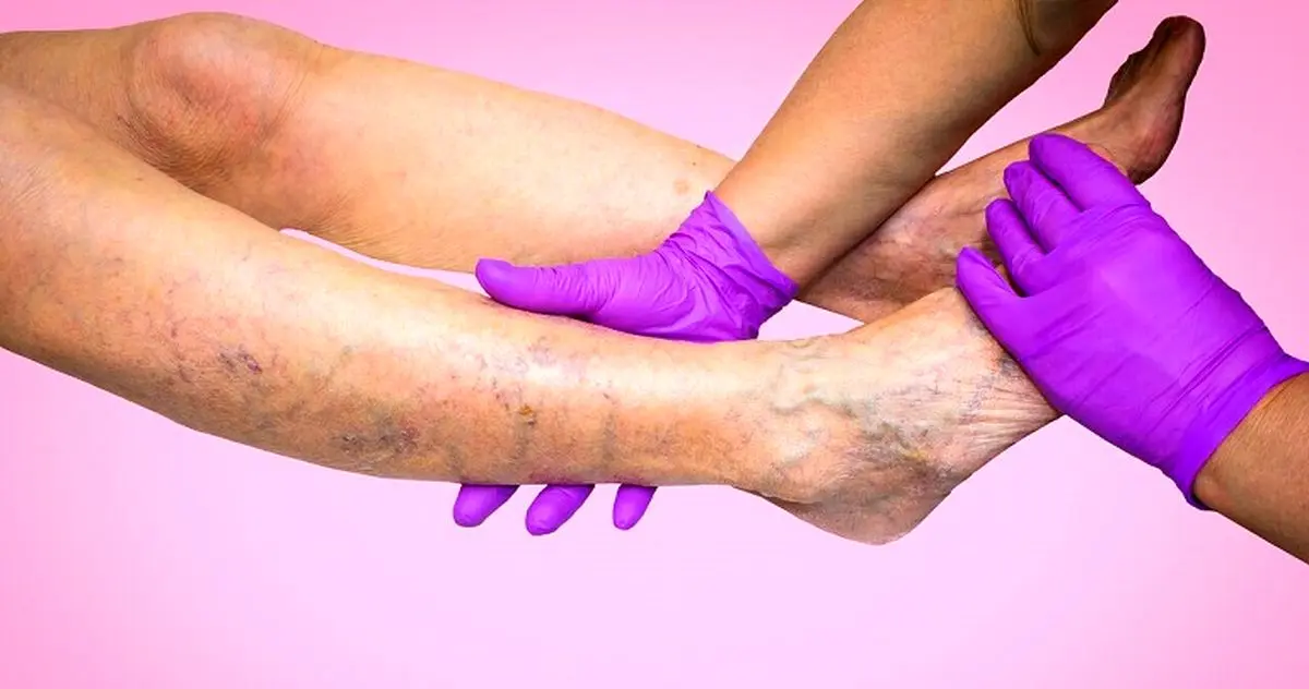 عارضه‌های بیماری واریس که حتما باید درباره آنها بدانید