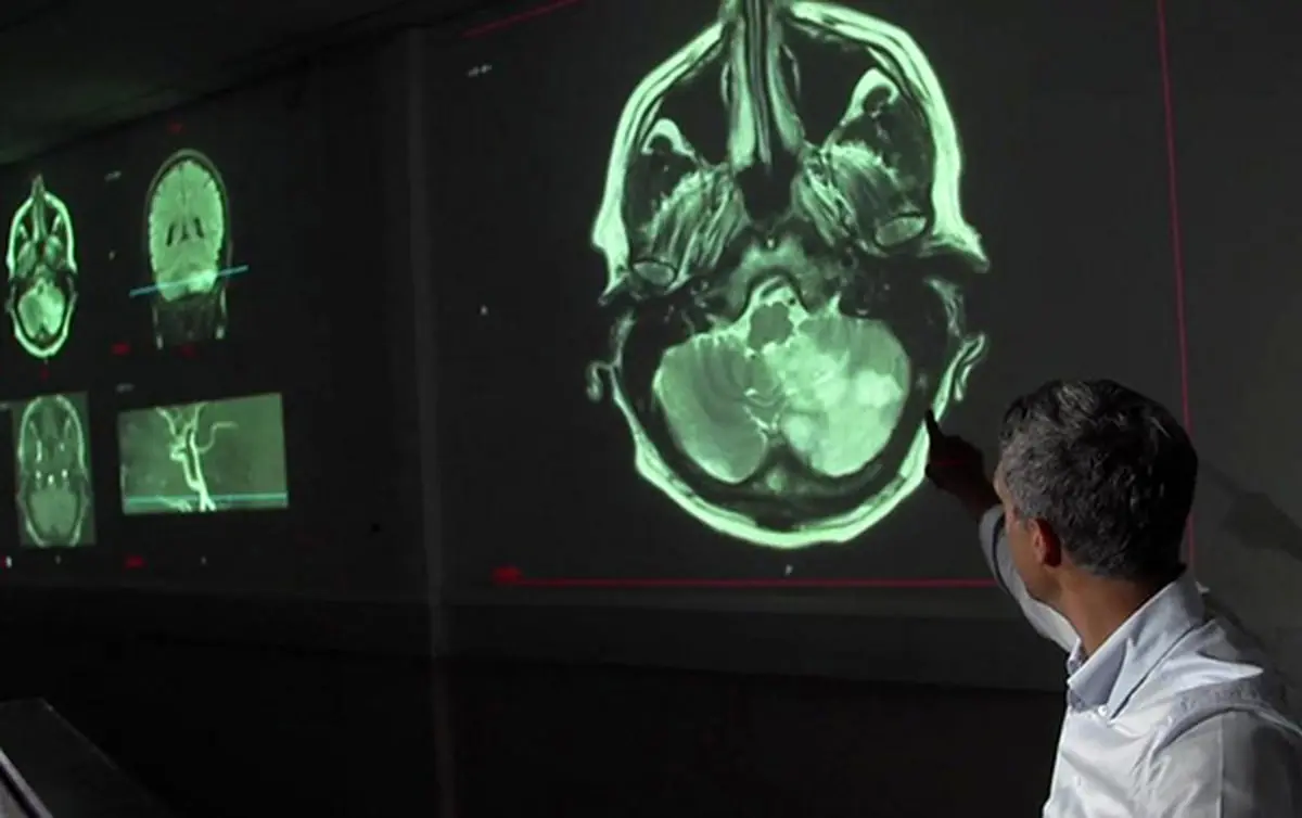 تونل ‌ویژه ویروس کر‌ونا ‌از ‌بینی به مغز!