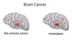 از علائم سرطان مغز چه می‌دانید؟ + راه‌های تشخیص