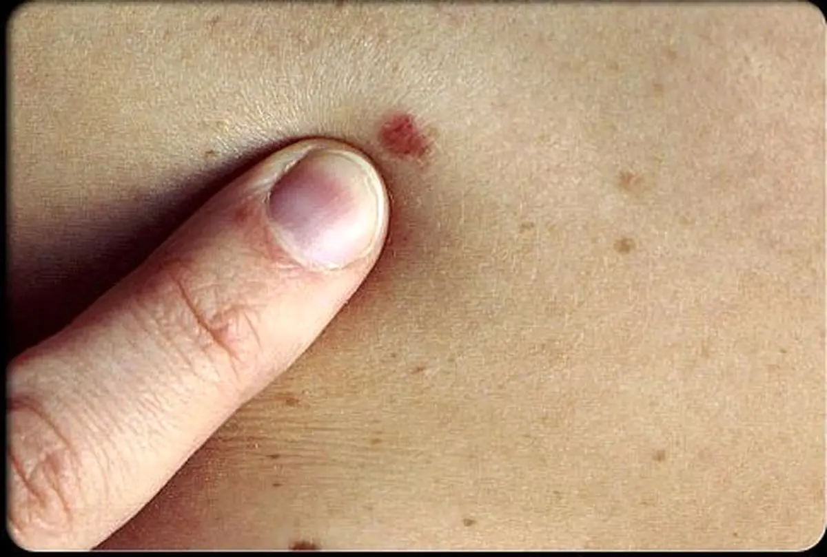 خال‌ها با خراش سرطانی می‌شوند