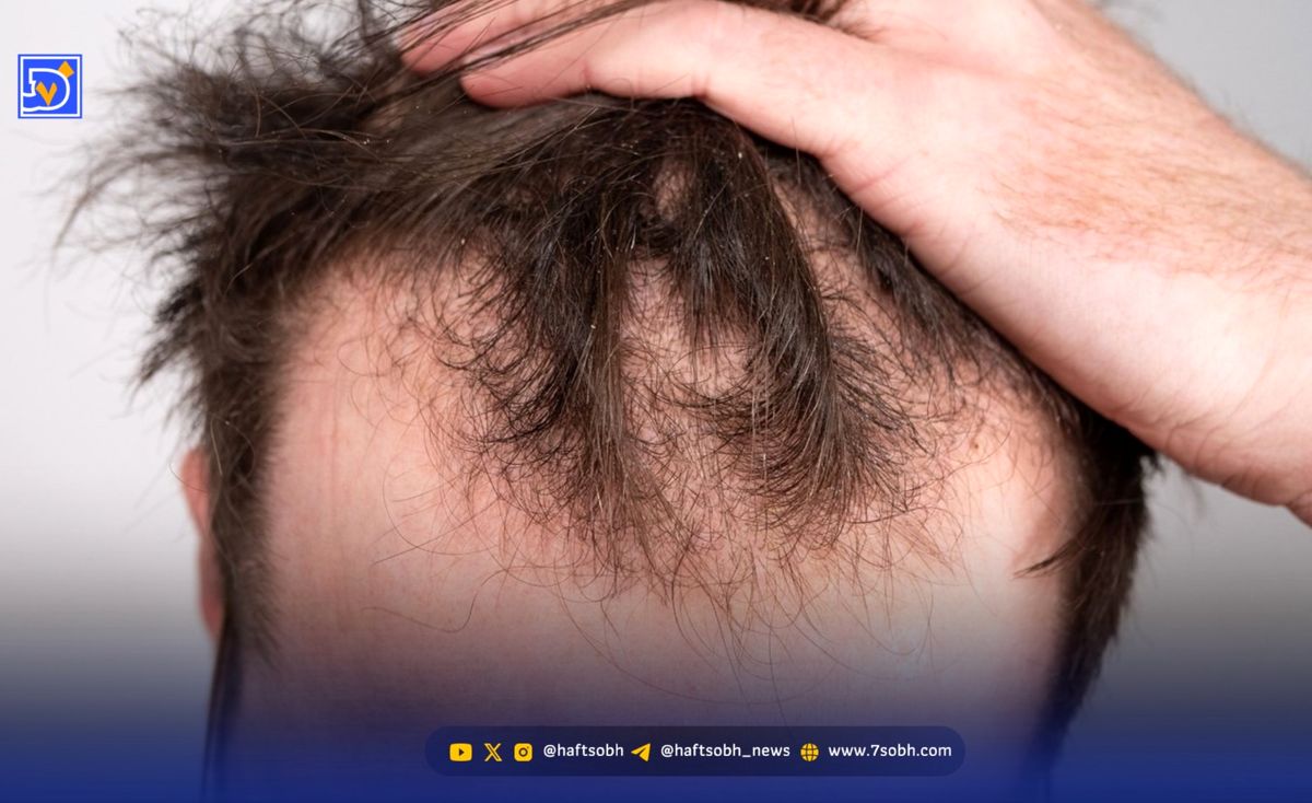 دستاورد دانشمندان تایوانی؛ درمان ریزش مو در ۲۰ روز با یک سرم ساده