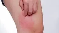 کهیر پوستی چیست و چگونه درمان میشود ؟