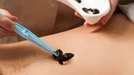 چه کسانی نباید زالودرمانی انجام دهند؟