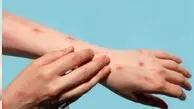 آبله میمونی مشابه کووید نیست