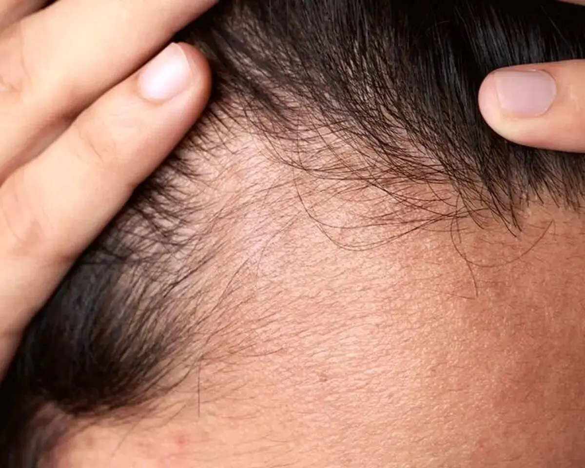درمانی جدید برای ریزش مو
