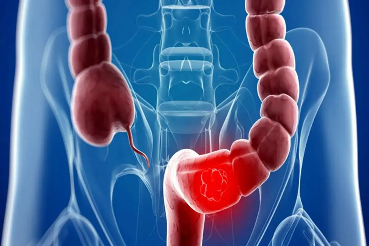 پیشگیری از سرطان روده با یک خوراکی ساده
