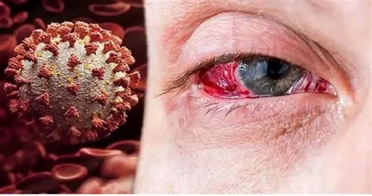 هشدار جدی ! مراقب ویروس جدید باشید کرونای چشمی