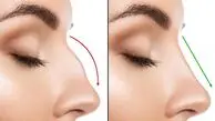 عمل بینی در سال ۱۴۰۴ چند می‌افتد؟