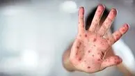 منشا ویروس سرخک