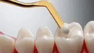 لمینت و کامپوزیت برای همه مناسب نیست