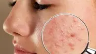 بیماری‌های پوستی شایع در تابستان