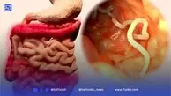 رفع درد با این انگل ترسناک