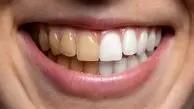 دندان سیگاری ها ۴ برابر افراد دیگر خراب می‌شود