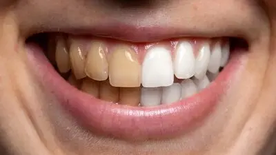 دندان سیگاری ها ۴ برابر افراد دیگر خراب می‌شود