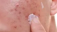 آشنایی با انواع لک‌های پوستی