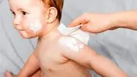 بهترین روش‌های درمان خانگی اگزمای پوستی در کودکان